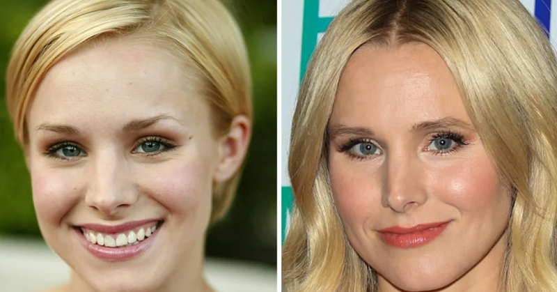 Did Kristen Bell Have Plastic Surgery